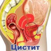 Лечение цистита